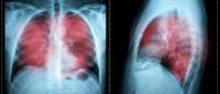 colorized chest xray